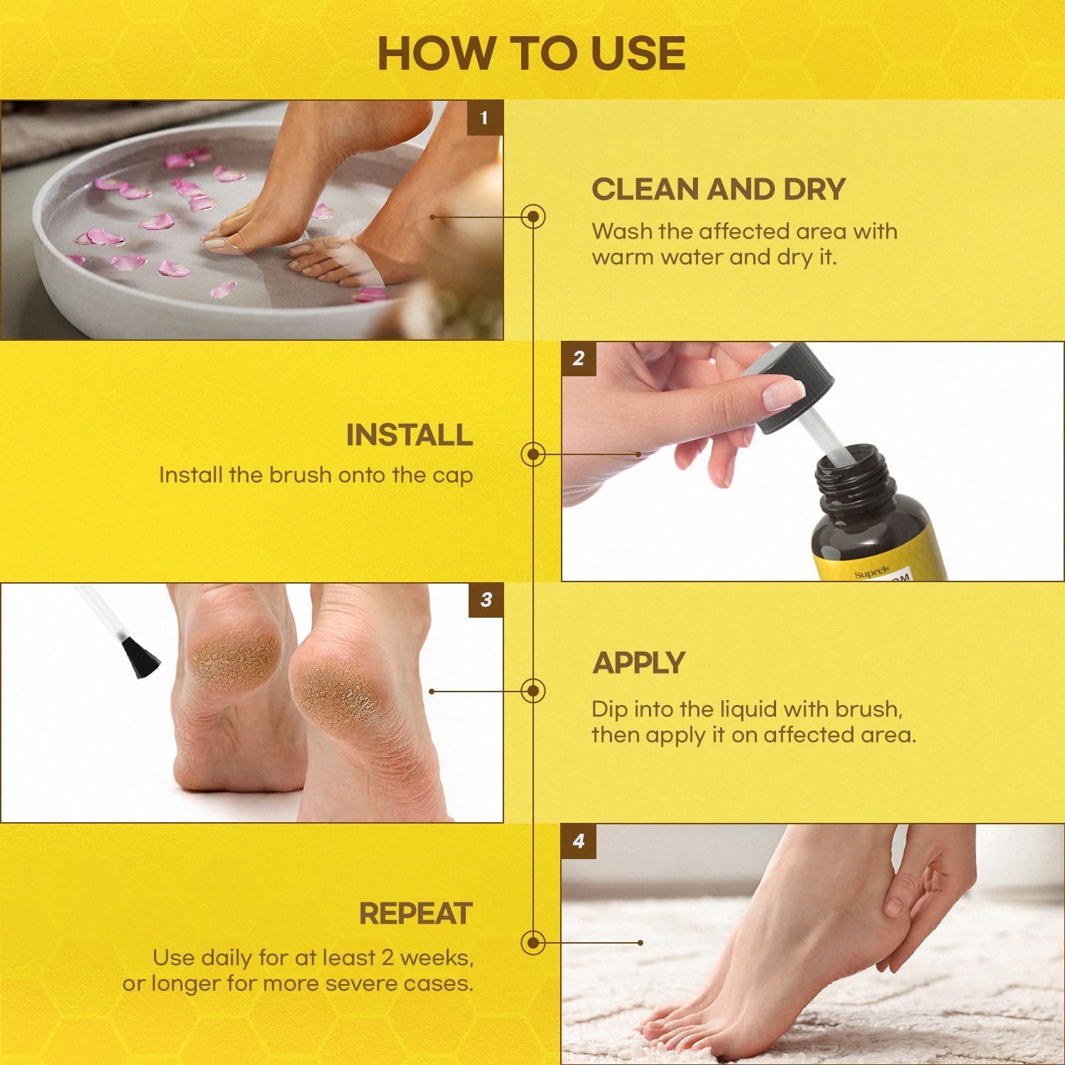 Fast-Acting bee Venom wart Remover