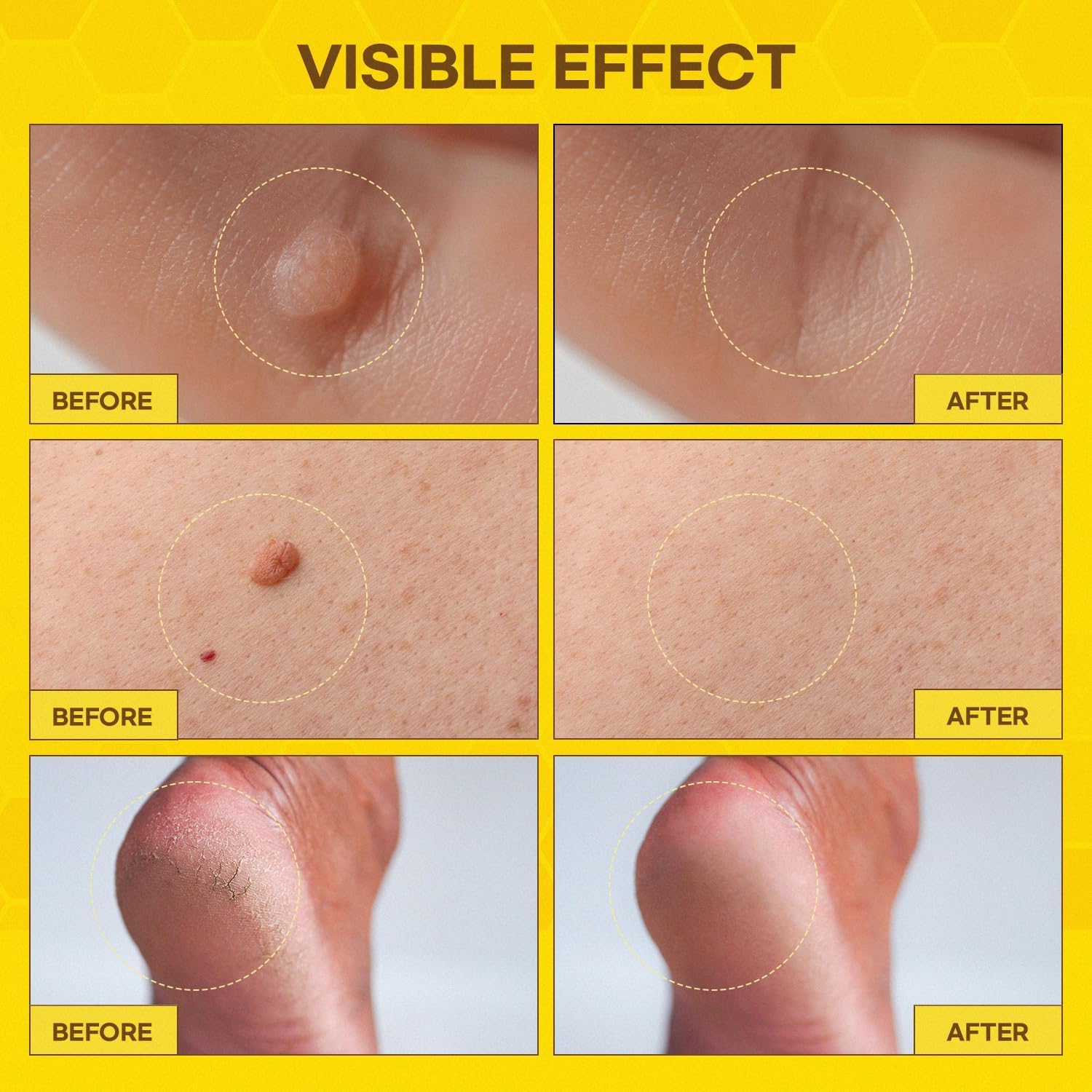 Fast-Acting bee Venom wart Remover