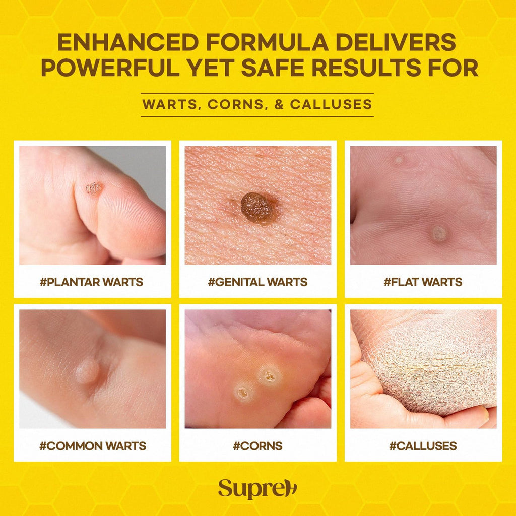 Bee Venom Wart Remover Kit