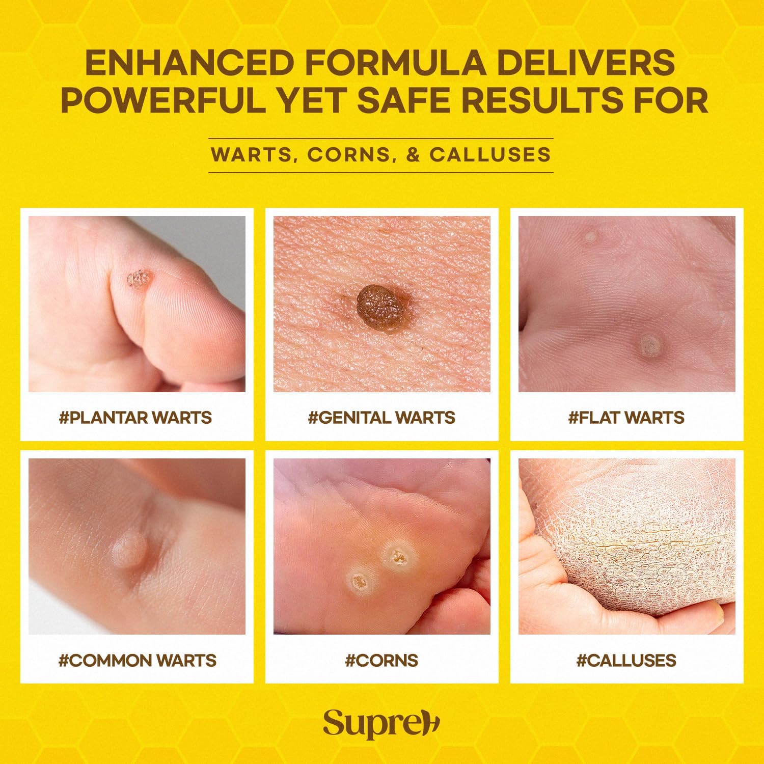 Bee Venom Wart Remover Kit